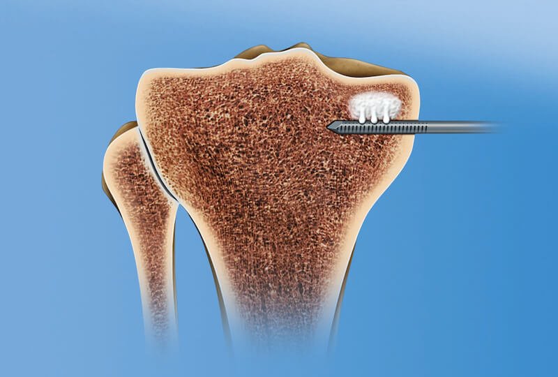Subchondroplasty (SCP) in Singapore Minimally Invasive Alternative To